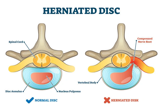 anatomy comparison of normal spinal disc versus herniated disc