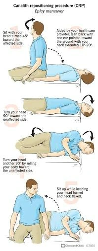clinical steps of the epley maneuver for treating positional vertigo